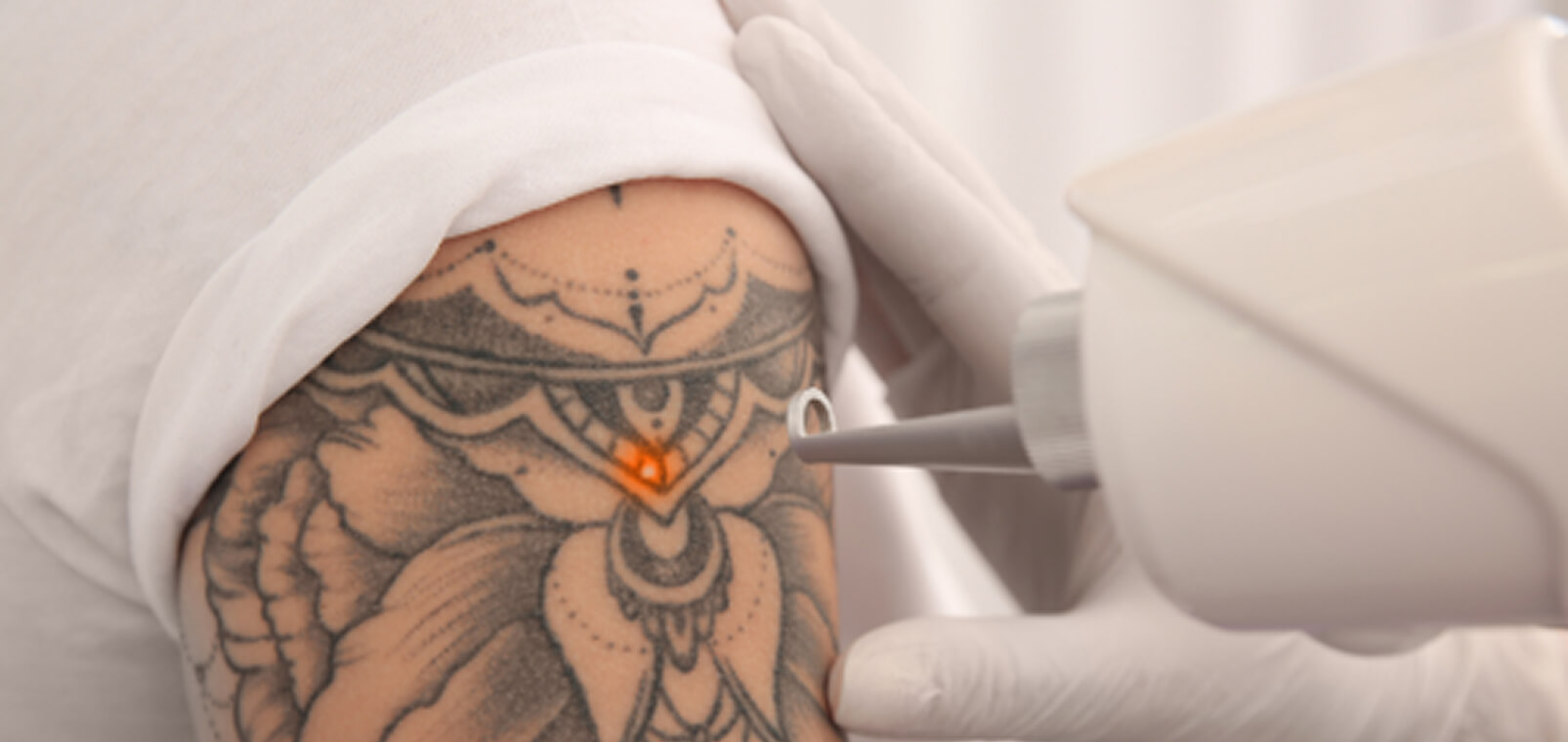 Sessão de remoção de tatuagem a laser na Estilo Laser, em Taguatinga
